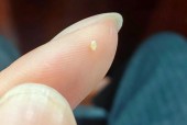 芝麻毛孔怎么办，芝麻毛孔是啥？
