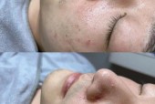 黑芝麻进入毛孔？黑芝麻堵住毛孔？