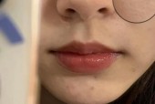 芝麻嵌在毛孔里？芝麻在毛孔里用牙签挑图？