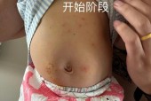 水猴子疣用什么药膏治疗？水猴子疣用什么药膏治疗不用夹子夹能好吗？