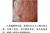 蛋皮长了个小疙瘩图片，睾丸长了像痘痘图片