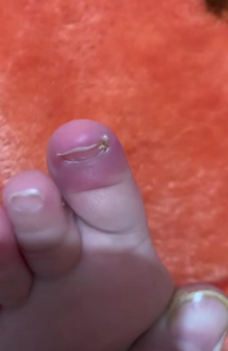 芝麻洗澡嵌进皮肤里，芝麻洗澡嵌进皮肤里会怎么样  第2张
