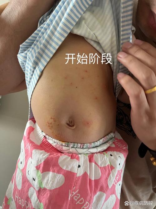 水猴子疣用什么药膏治疗？水猴子疣用什么药膏治疗不用夹子夹能好吗？  第1张