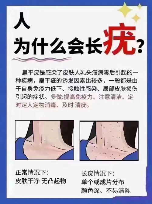 水猴子疣用什么药膏治疗？水猴子疣用什么药膏治疗不用夹子夹能好吗？  第5张