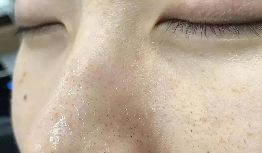 汗毛孔芝麻，汗毛孔芝麻图片？  第3张