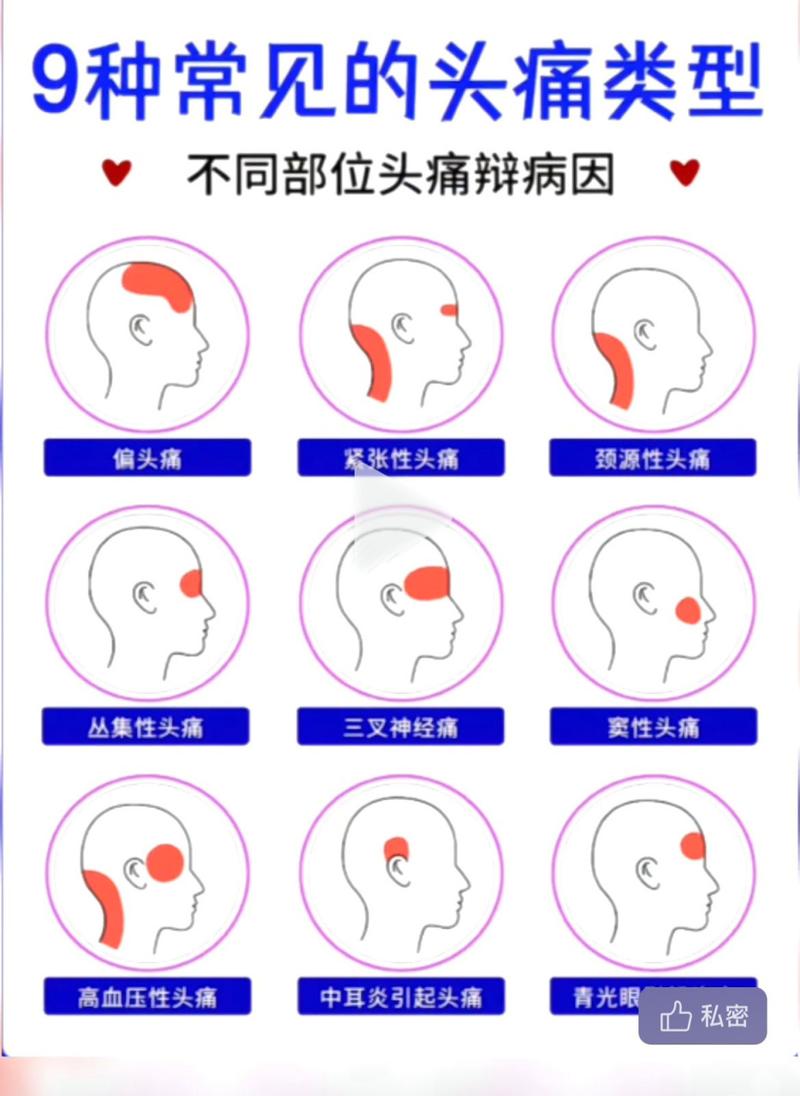怎么区分偏头痛和神经性头痛，三叉神经疼的6个症状  第1张