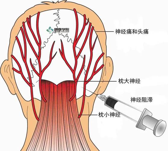 怎么区分偏头痛和神经性头痛，三叉神经疼的6个症状  第5张