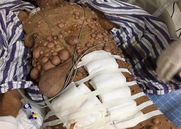 玉米男孩得的病是什么病，玉米男孩得了什么病?？  第5张
