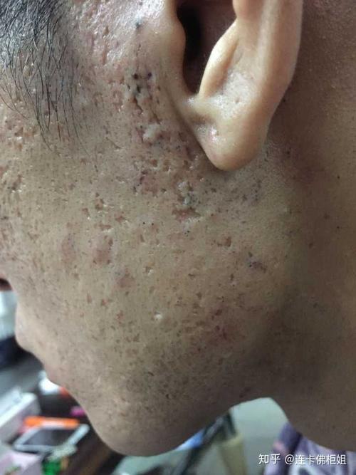 芝麻毛孔图？芝麻毛孔图片男孩？  第4张