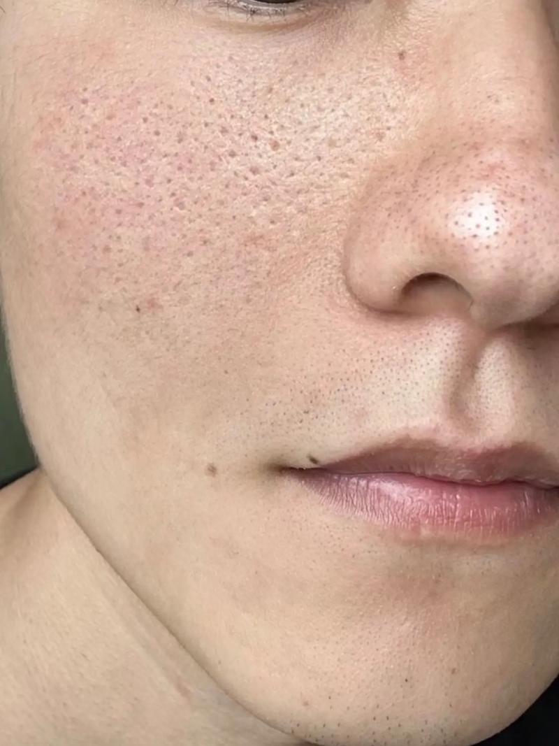 芝麻毛孔图？芝麻毛孔图片男孩？  第5张