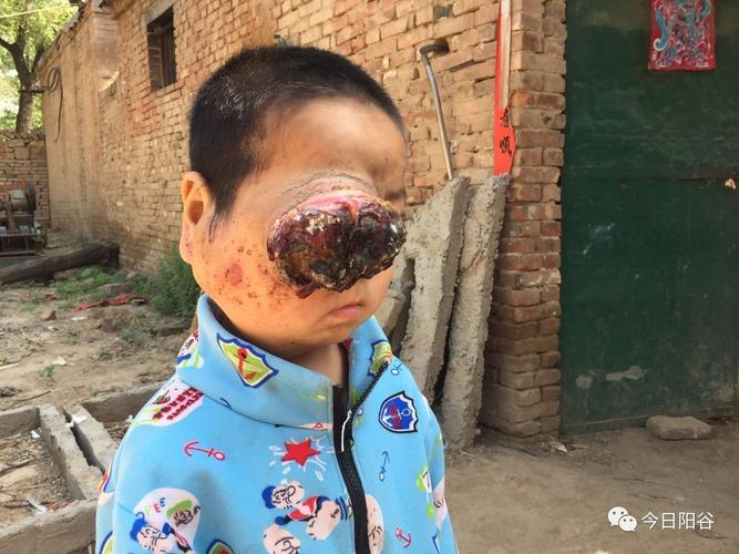 玉米男孩寄生虫照片？玉米男孩到底得了什么病？  第6张