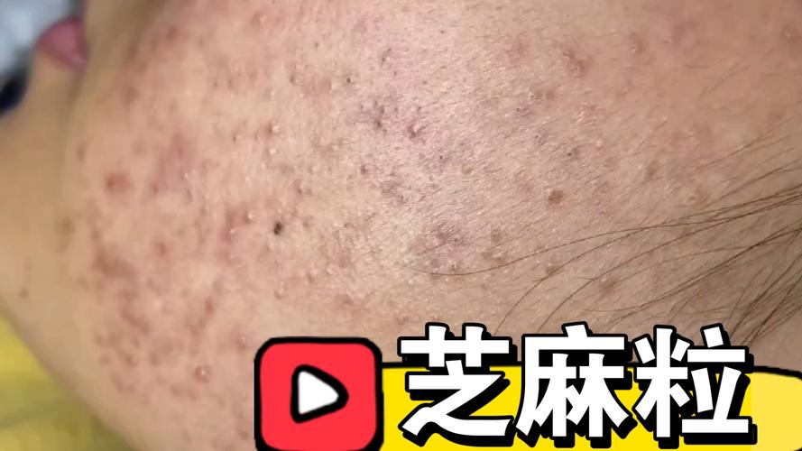 毛孔挑芝麻？芝麻填满毛孔？  第2张