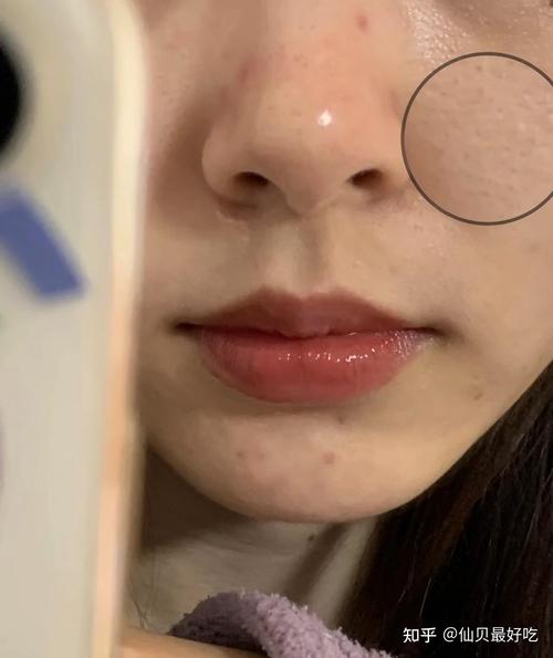 芝麻嵌在毛孔里？芝麻在毛孔里用牙签挑图？  第1张