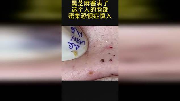 芝麻大毛孔女孩泡澡，芝麻毛孔 女孩  第4张