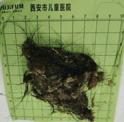 芝麻女孩是什么病，芝麻女孩得的是什么病？  第2张
