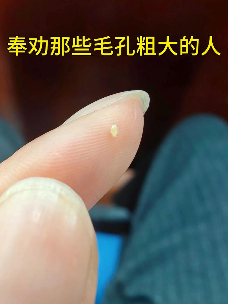 芝麻毛孔怎么办，芝麻毛孔是啥？  第1张