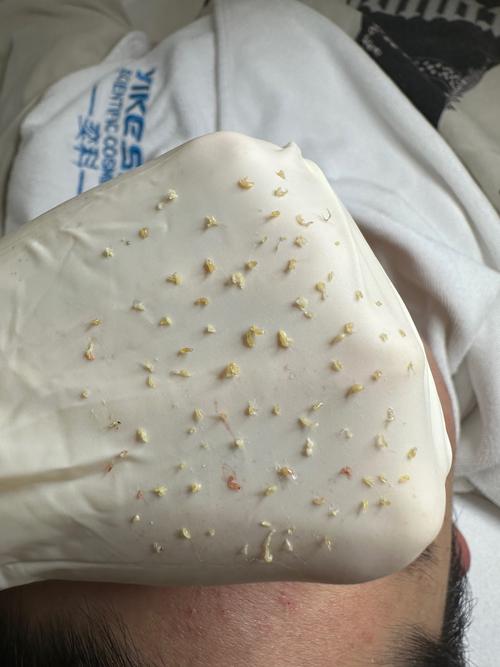 芝麻毛孔怎么办，芝麻毛孔是啥？  第2张