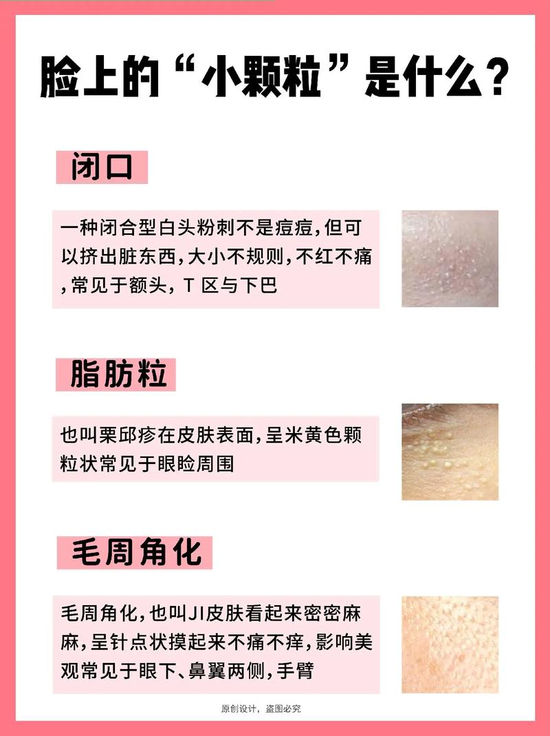 芝麻毛孔怎么办，芝麻毛孔是啥？  第6张