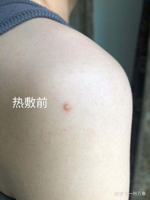 皮肤软疣水猴子图片，皮肤水猴子长什么样子？  第3张
