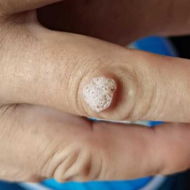 皮肤软疣水猴子图片，皮肤水猴子长什么样子？  第5张