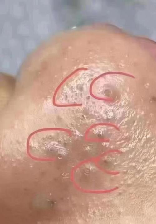 芝麻钻入全身毛孔图，芝麻钻进皮肤？  第2张