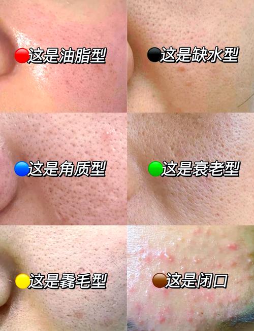 芝麻钻入全身毛孔图，芝麻钻进皮肤？  第6张