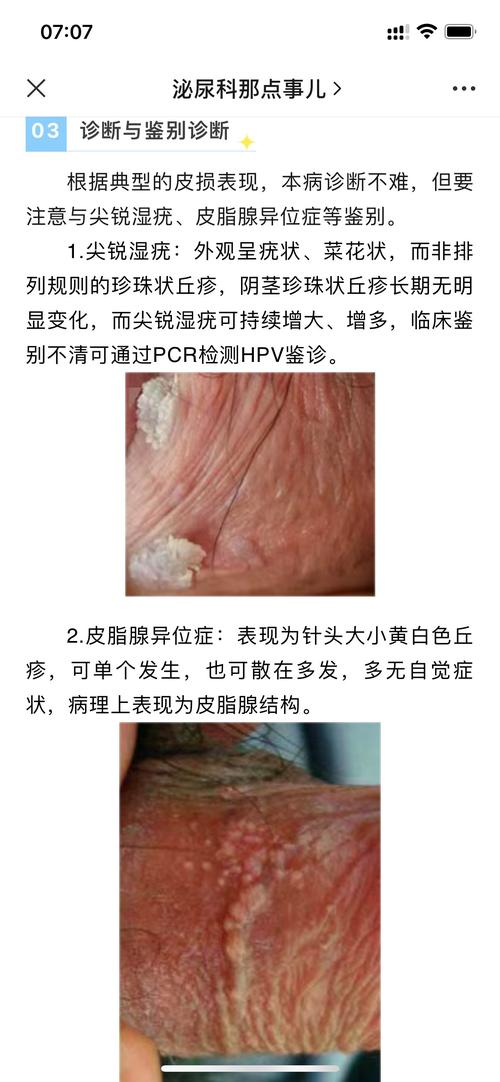 蛋皮长了个小疙瘩图片，睾丸长了像痘痘图片  第1张